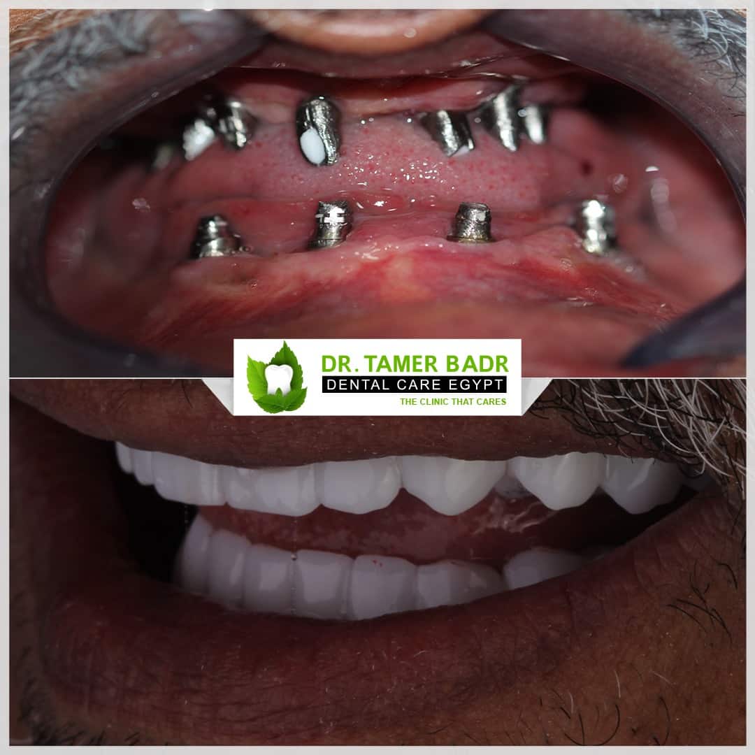 Dintal-Implant-Dental-Care-Egypt