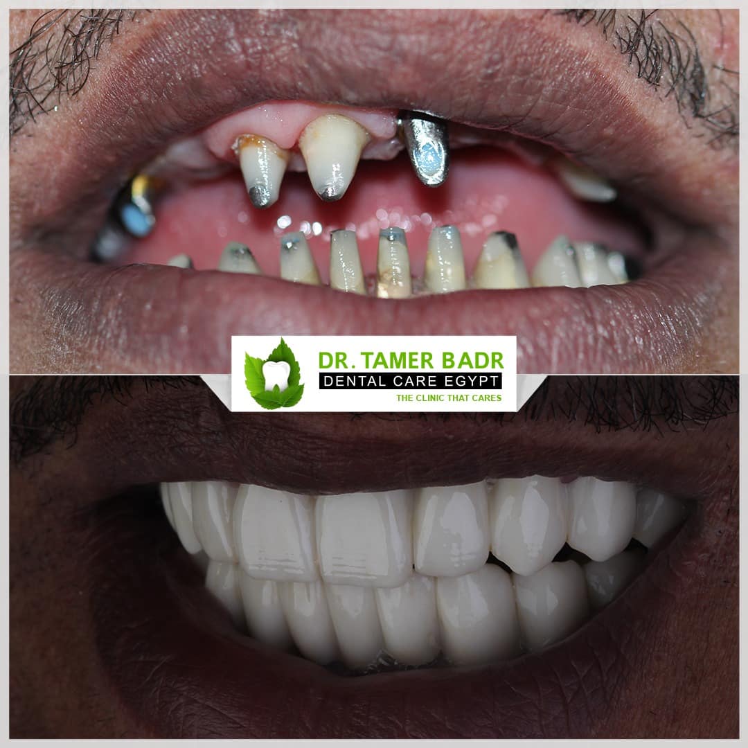 Dental Emplant -D-C-E