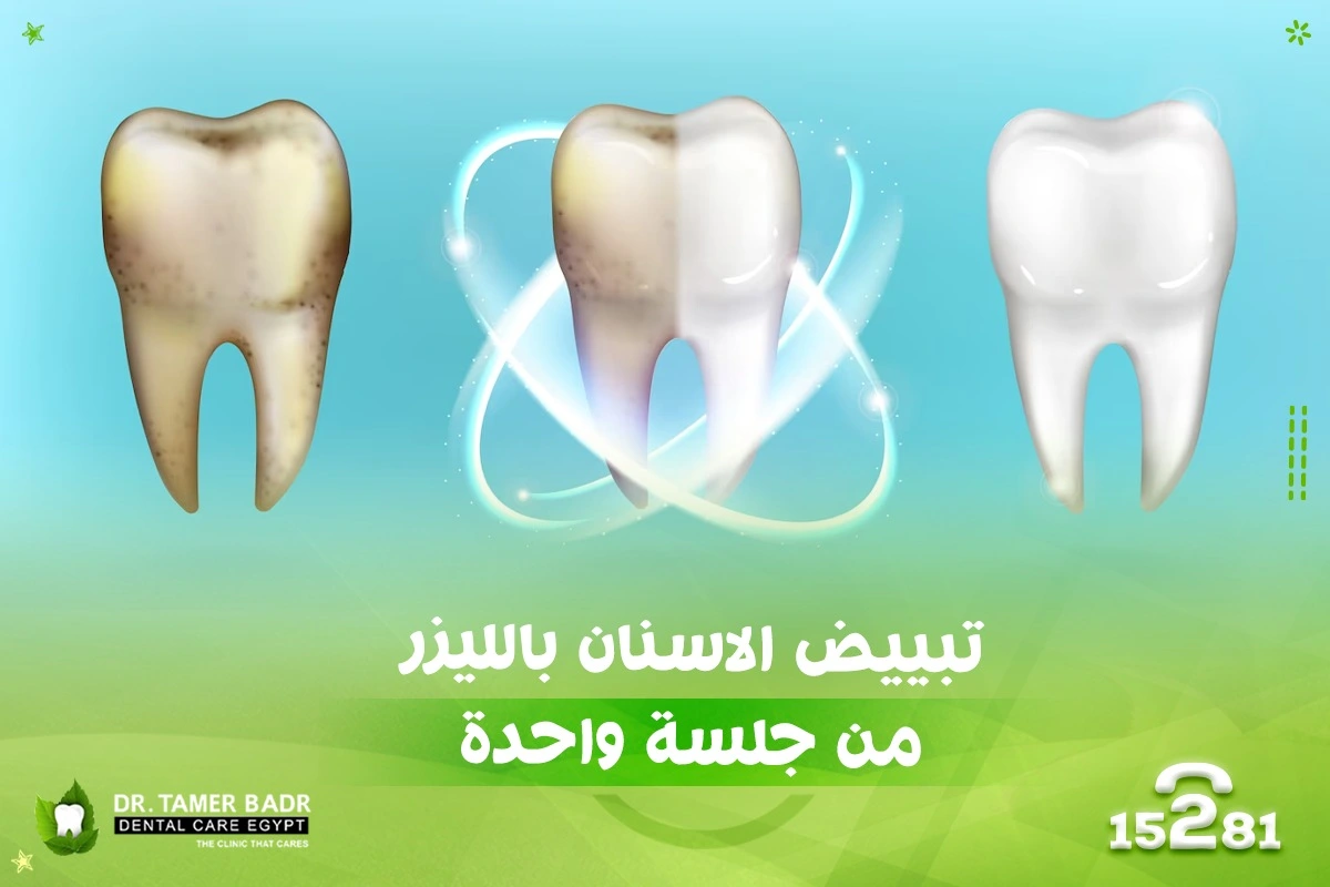 تبييض الاسنان بالليزر من جلسة واحدة Dental Care Egypt Dr Tamer Badr