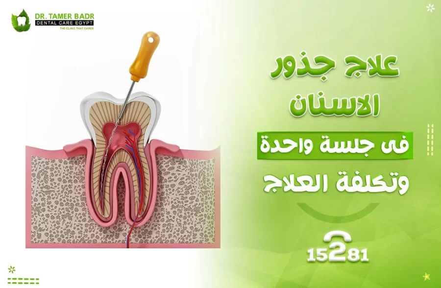 علاج جذور الاسنان فى جلسة واحدة