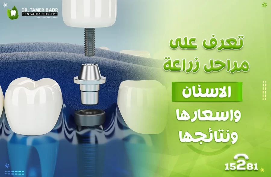 مراحل زراعة الاسنان
