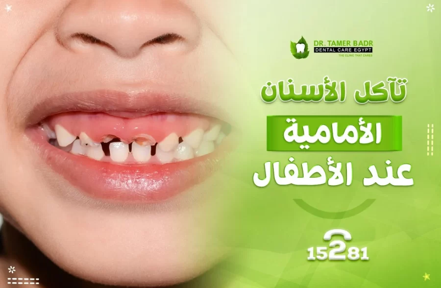 تآكل الأسنان الأمامية عند الأطفال