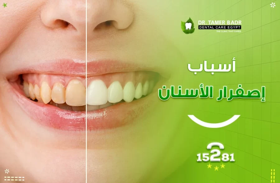 اسباب اصفرار الاسنان