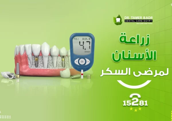 زراعة الاسنان لمرضى السكر