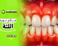 ما هي أسباب تورم اللثة وما هي طرق العلاج وطرق الوقاية؟