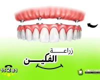 زراعة الفكين بأحدث تكنولوجيا طبية لزراعة الأسنان