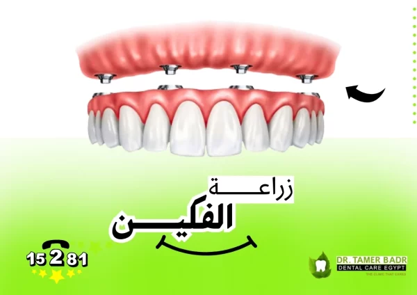 زراعة الفكين