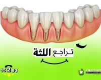 أسباب تراجع اللثة والأعراض وطرق العلاج