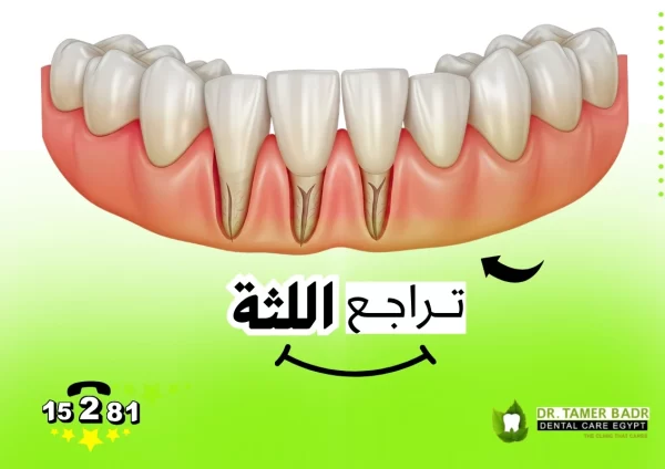 تراجع اللثة