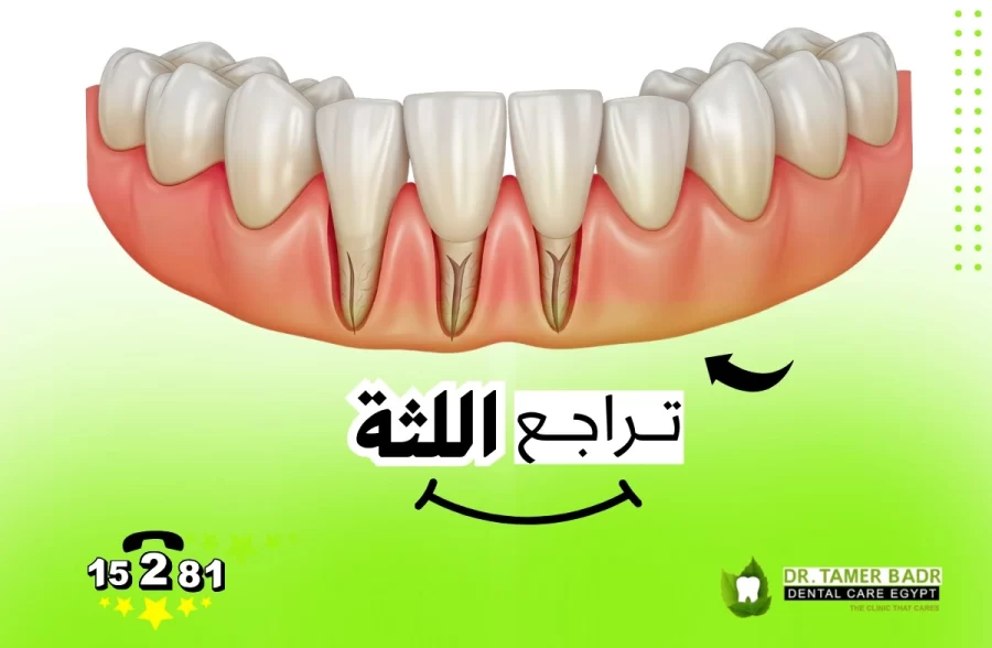 تراجع اللثة