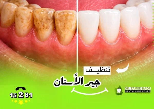 تنظيف جير الاسنان