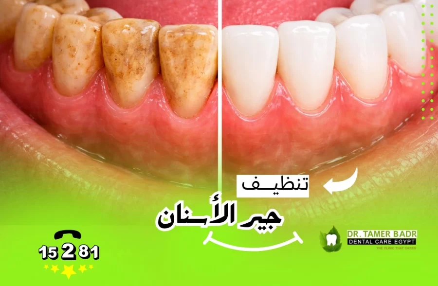 تنظيف جير الاسنان