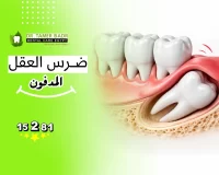 أعراض ضرس العقل المدفون ومتى يجب خلعه