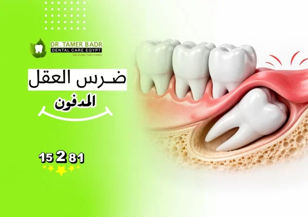 ضرس العقل المدفون