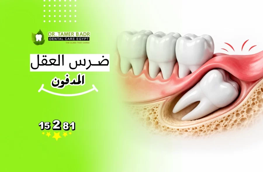 ضرس العقل المدفون