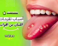 أسباب تقرحات اللسان من الجوانب وأعراضها وطرق الوقاية