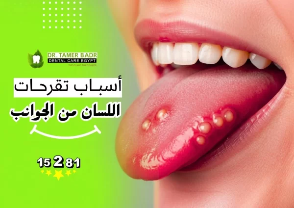 أسباب تقرحات اللسان من الجوانب