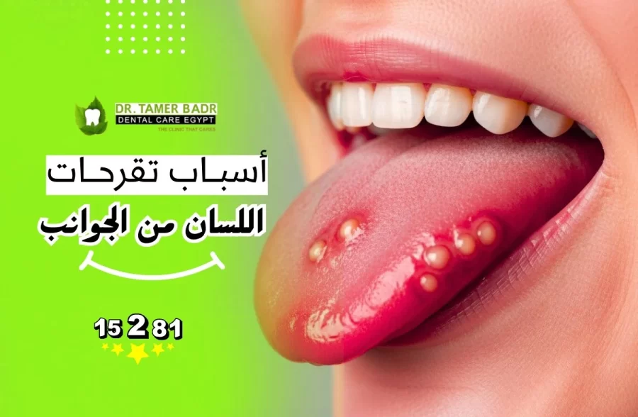 أسباب تقرحات اللسان من الجوانب