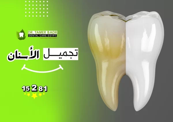 تجميل الاسنان
