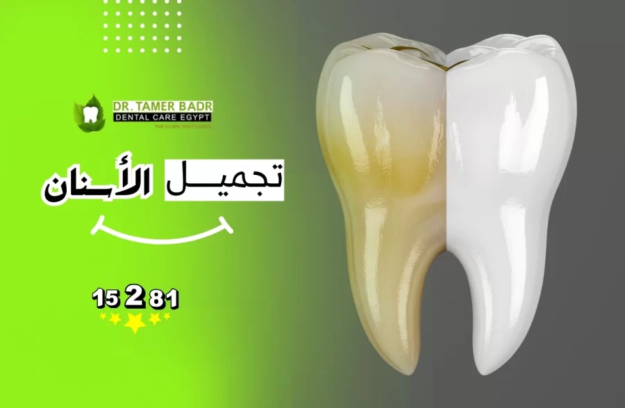 تجميل الاسنان