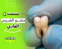 خطوات حشو الضرس العادي ومميزات وعيوب الحشوات