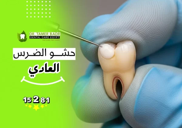 حشو الضرس العادي