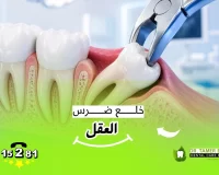 متى يجب خلع ضرس العقل؟ الأعراض والحالات الشائعة