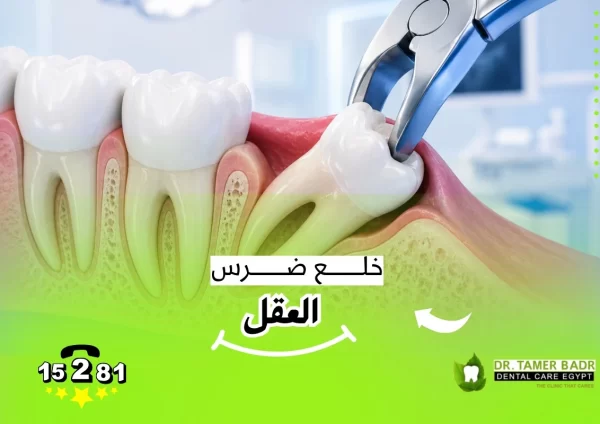 خلع ضرس العقل