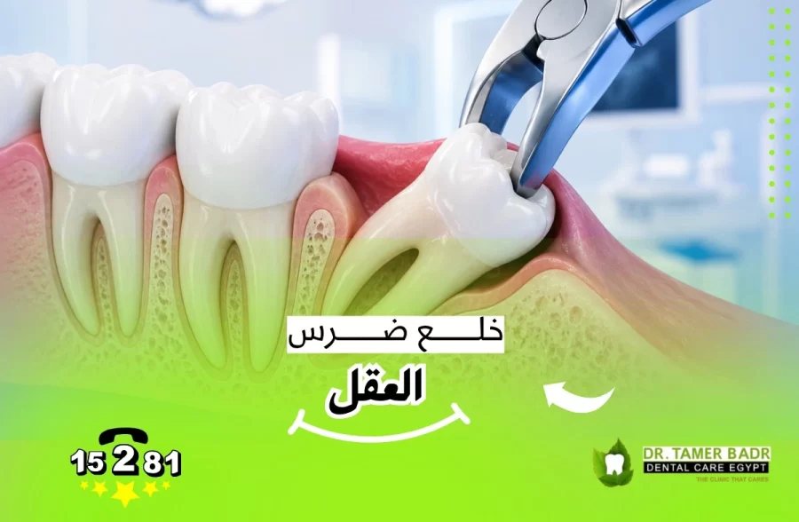 خلع ضرس العقل