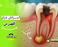 تعرف علي أهم أعراض خراج الضرس وأسبابه وتجنب المضاعفات