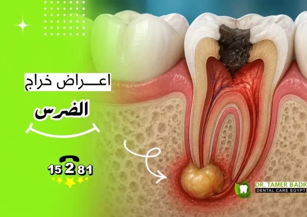 أعراض خراج الضرس