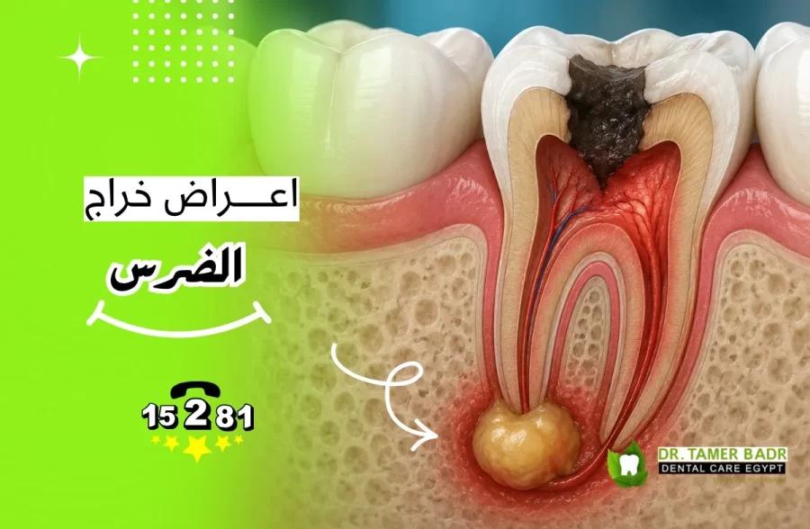 أعراض خراج الضرس