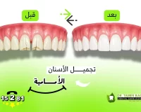 طرق وأساليب تجميل الأسنان الأمامية ومتى تُستخدم كل طريقة منهم