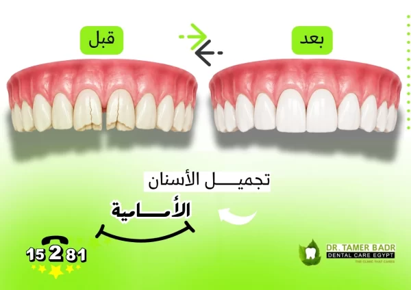 تجميل الأسنان الأمامية