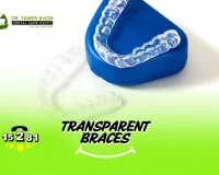Types of Transparent Braces, Advantages and Disadvantages