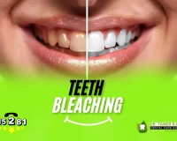 Types of Teeth bleaching and Ways to Maintain Results