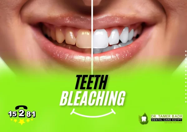 teeth bleaching