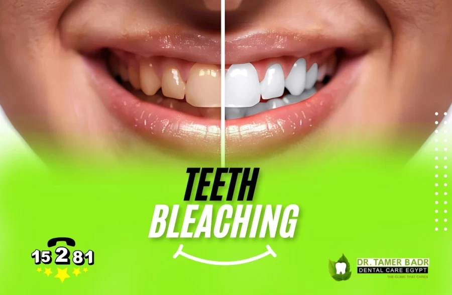 teeth bleaching